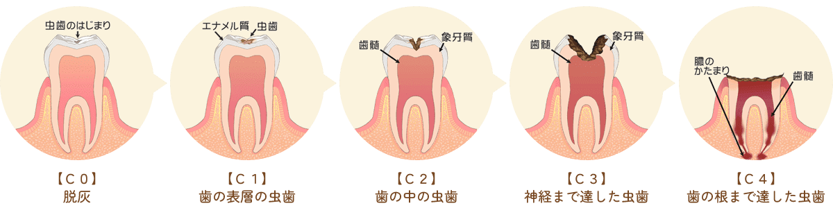 虫歯治療
