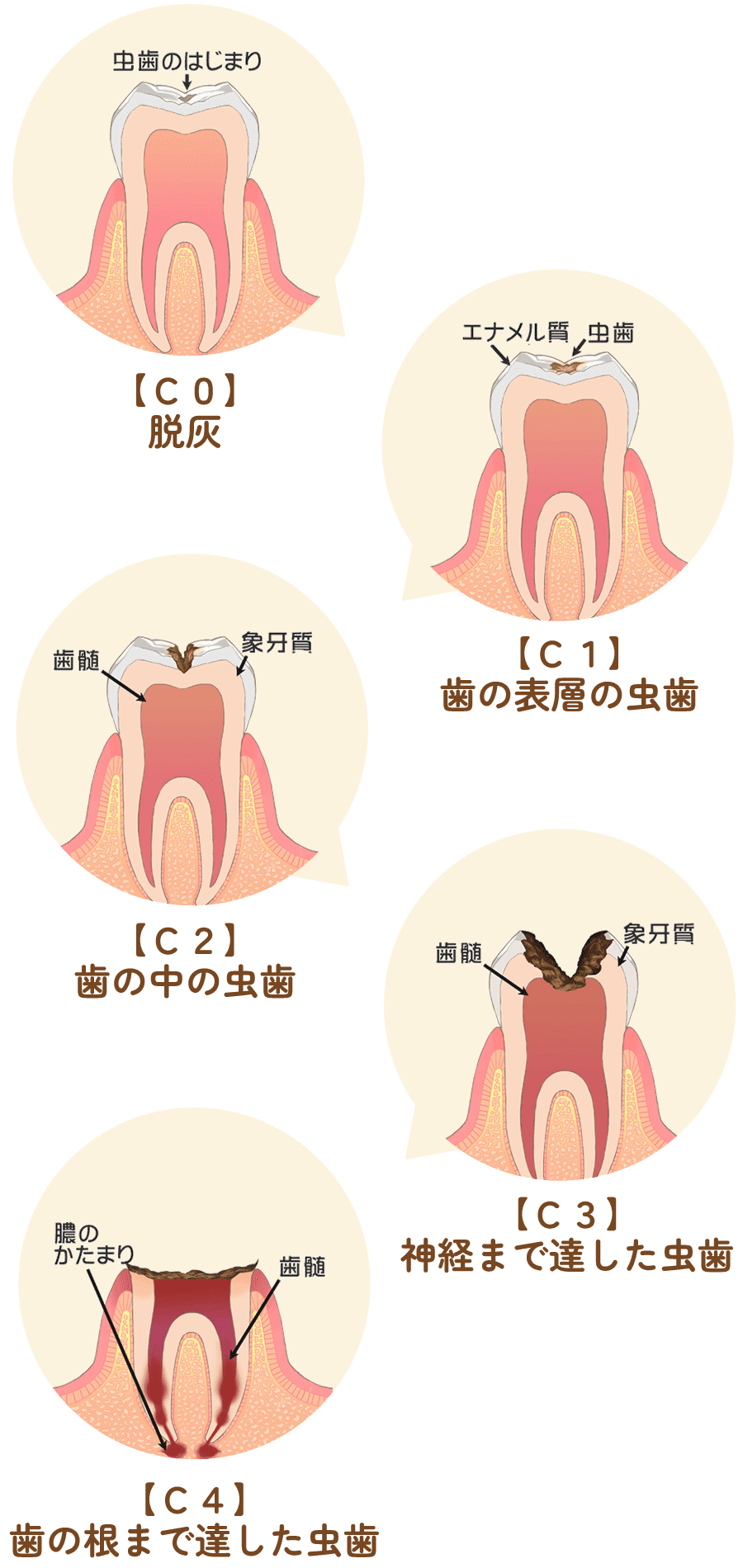 虫歯治療