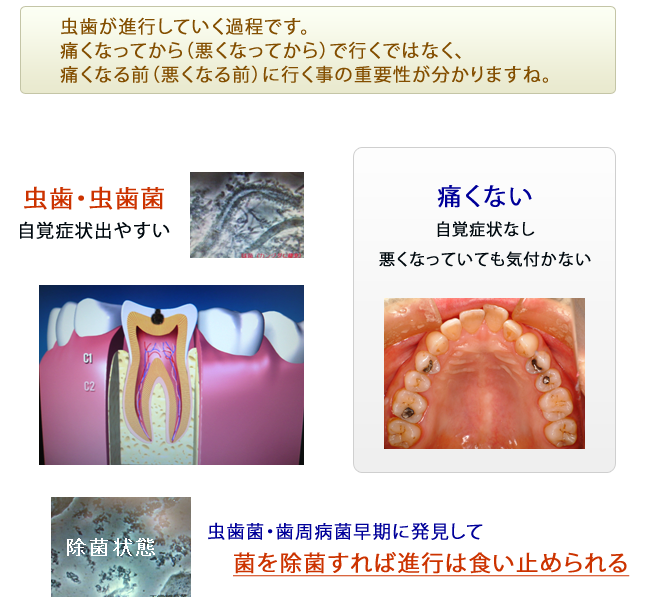 虫歯進行過程