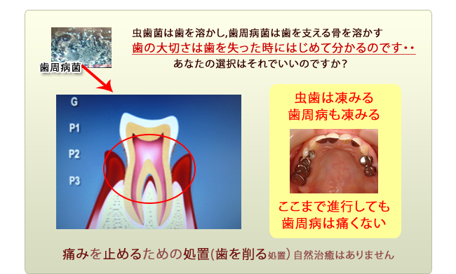 歯周病進行過程