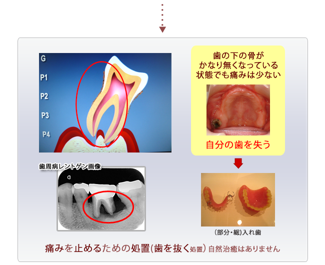 歯周病進行過程